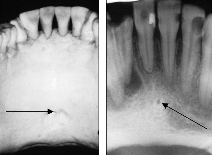 Mandibular Anterior Landmarks - Intraoral Radiographic Anatomy - Dentalcare