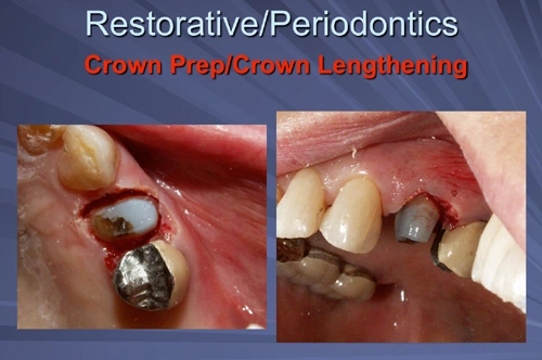 This image depicts the tooth is built up with a high contrast composite material and prepared for the crown on the same appointment as the crown lengthening.