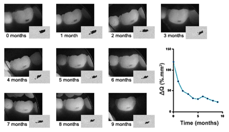 QLF photos shown are research images showing remineralization of a white-spot lesion over a 9 month time period