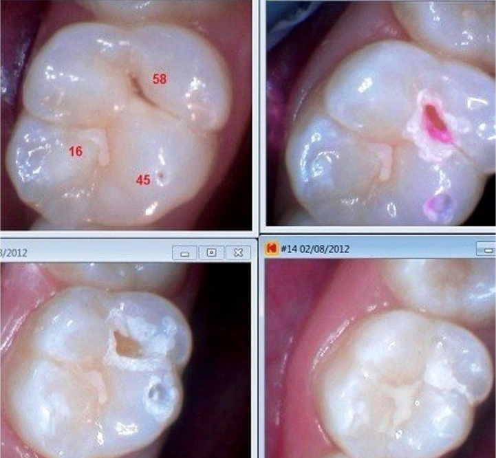 Restorative Dentistry | Lasers in Dentistry: Minimally Invasive ...