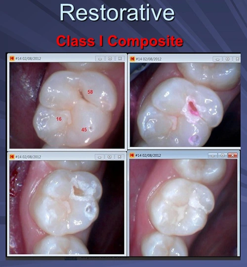This image depicts a series of four photos showing the steps for a Class I Composite restoration.