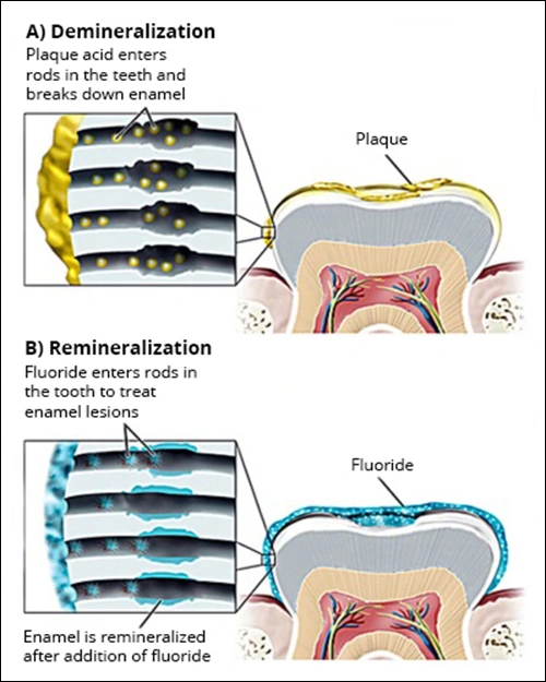 Image: (A) Plaque acids cause a demineralized, sub-surface lesion. (B) Fluoride treatments remineralize the lesion with a more resistant fluorapatite.