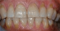 Photo of teeth with hard tissue loss involving 50% of surface area