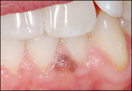 Melanocytic Lesions | A Guide to Clinical Differential Diagnosis of Oral  Mucosal Lesions | Continuing Education Course
