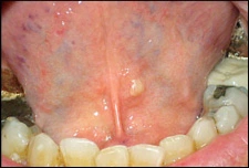 fig01-yellow-papule