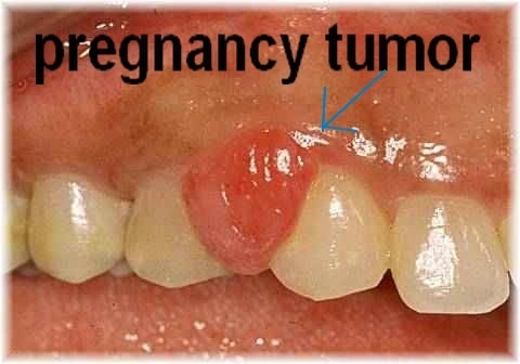 Pregnancy Gingivitis