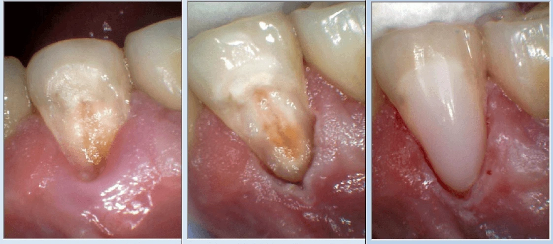This image depicts Captek crowns cemented three weeks after gingivoplasty and gingivectomy.