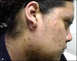 Image: Lesions and scabbing on face
