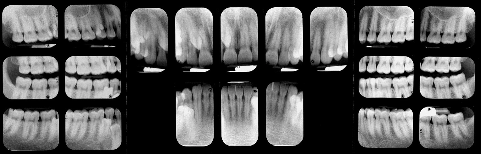 Alterations in the Number of Teeth - Figure 7