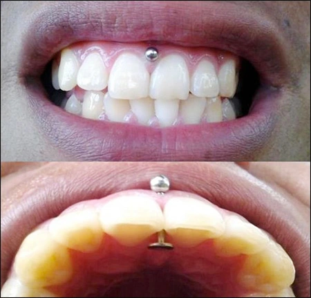 Photograph showing a gingival/trans-gum piercing.