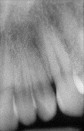 Conjoined Teeth - Figure 2