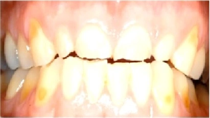 Photo showing facial view of dentition of a 23 year-old-male with ETW, a condition that can lead to poor aesthetics, sensitivity, loss of function, and sometimes loss of self-esteem.