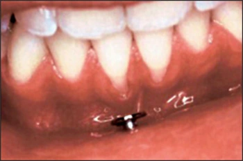 Image: Gingival recession