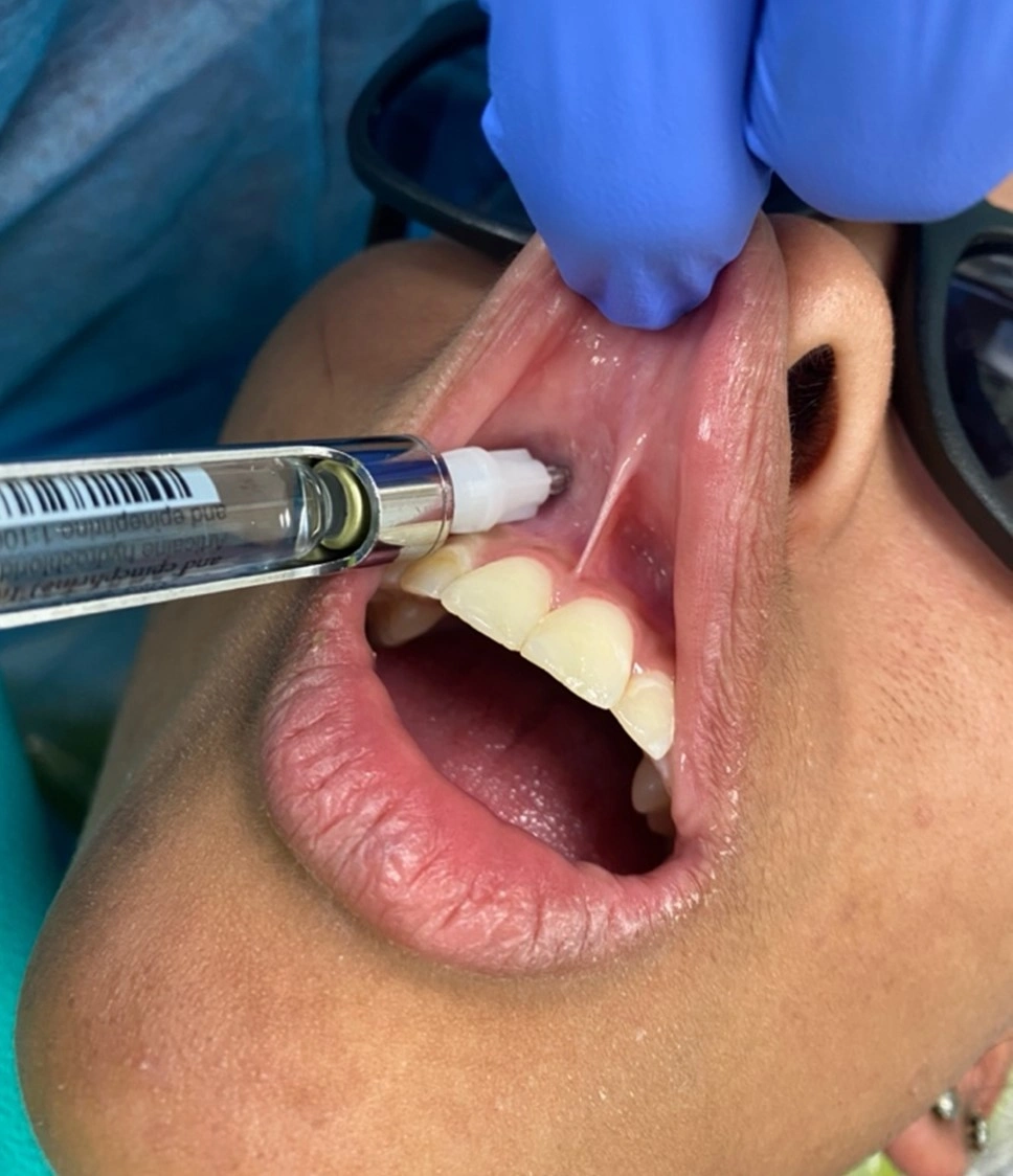Local Infiltration of the Maxillary Primary and Permanent Incisors and