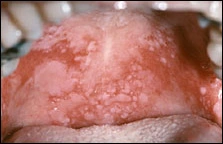 fig01-ulcerations-soft-palate