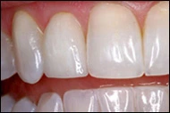 Tooth #7 Post-veneer cementation