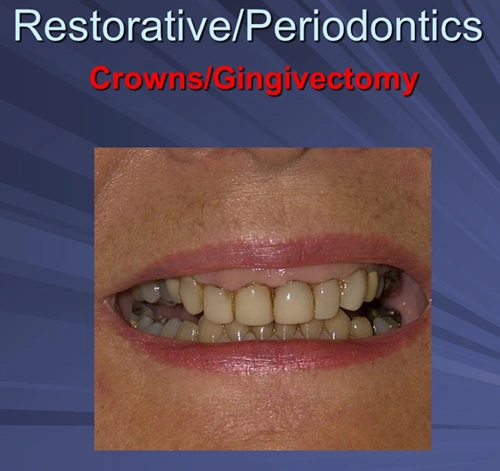 This image depicts pre-operative severe idiopathic gingival hyperplasia.