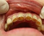 Photo of tooth erosion.