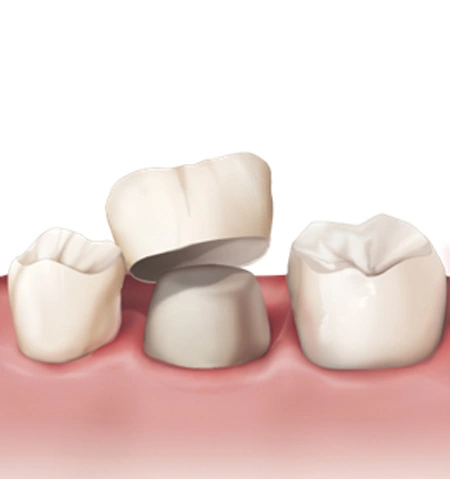 ce542 - Content - Crowns and Bridges - Figure 1