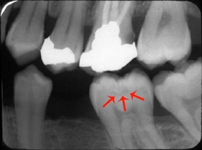Pit and Fissure Caries