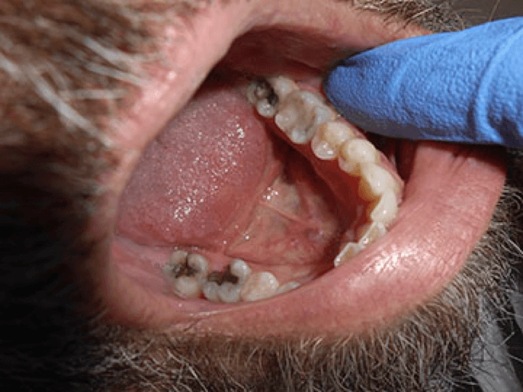 CE562 - Content - Palpation of the Buccal and Lingual/Palatal Gingival Tissue of the Tooth - Figure 1