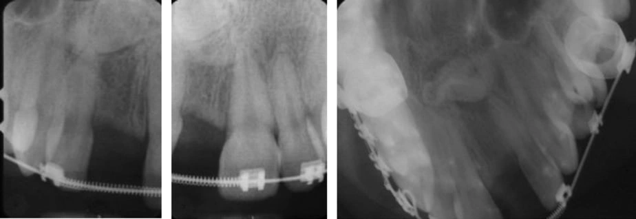 Figure 9. Periapical and Occlusal Images of an Odontoma.