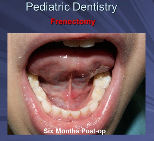 This image depicts the four-year-old male six month follow up and no relapse of the ankyloglossia is present.