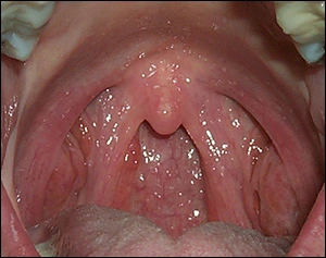 ce337 - Content - Posterior Pharyngeal Wall - Figure 1