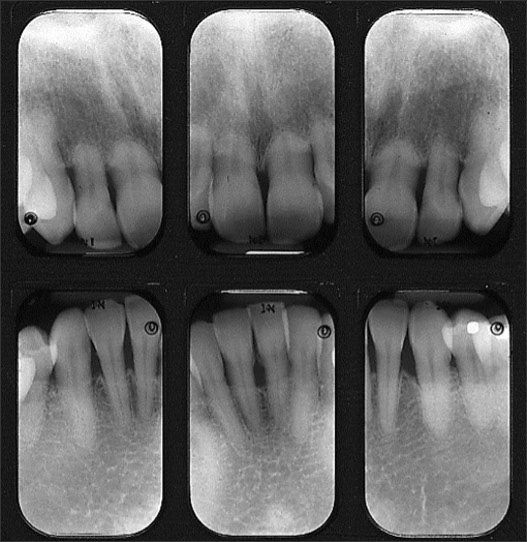 Anterior periapical radiographs of teeth with external resorption, especially severe on the maxilla