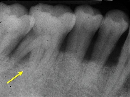 Supernumerary Roots - Figure 1