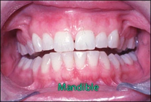 img21-mandible