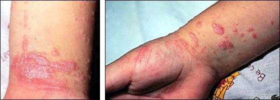 Image (left): Skin lesions of lichen planus