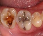 Photo of cavities in teeth.