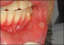 Image: Aphthous ulcers