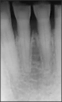 Periapical radiograph of anterior teeth with attrition