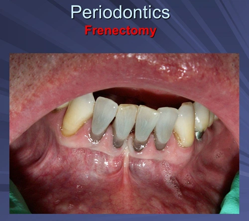 This image depicts frenum contributing to recession between teeth 24 and 25.