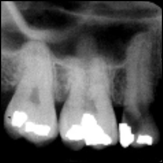 Intraoral Radiographic Anatomy - Dentalcare Course | Dentalcare