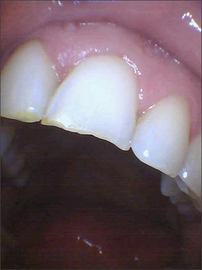 chips, smooth incisal