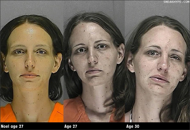 Image: Physical effects of methamphetamine use (female).