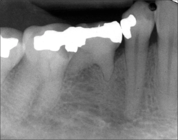 Alterations in the Number of Teeth - Figure 1