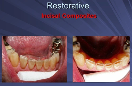 This image depicts incisal composites final preparations done anesthesia free with Er:YAG laser.