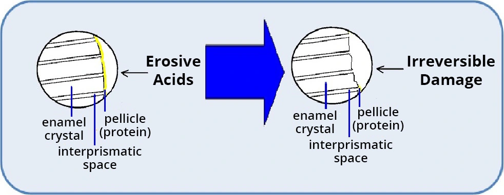 Diagram showing dental erosion.