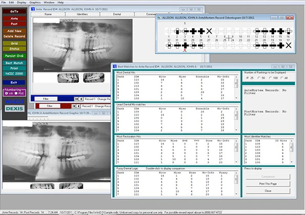 WinID showing best matches and comparison of ante-mortem and post-mortem radiographs.