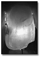 Image showing interproximal caries found using DIFOTI