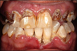 Image: Declining periodontal health