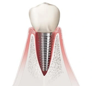 Implant crown