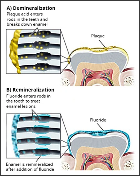 Diagram showing the presence of NCCL lesions suggesting the likelihood of improper brushing habits.