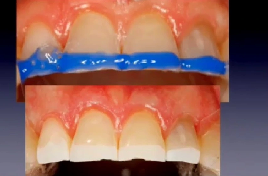 Photos showing typical etching pattern on teeth after use of a 37% phosphoric acid treatment.