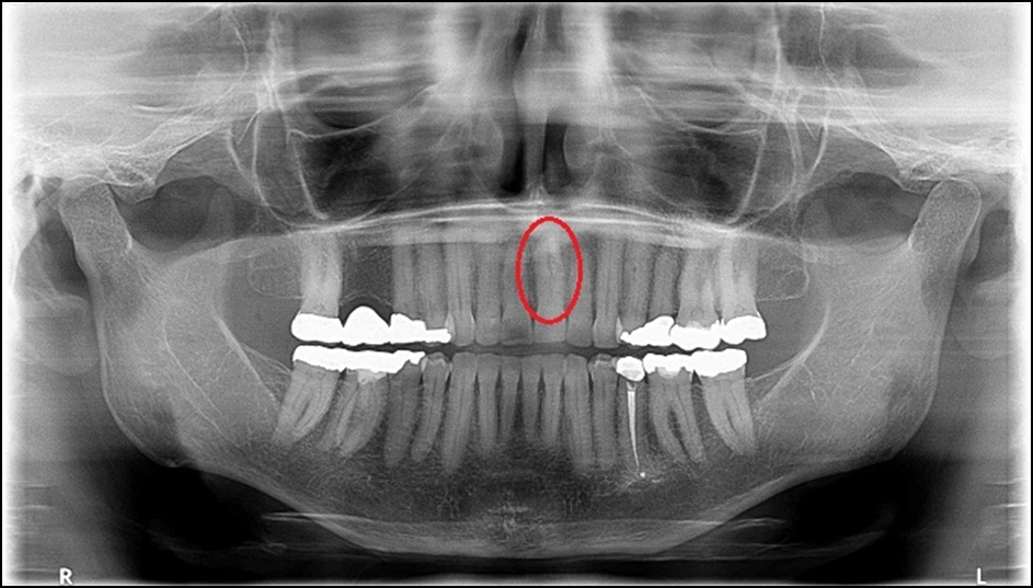 Use of Panoramic Imaging for Patient Education - Panoramic Radiographs ...