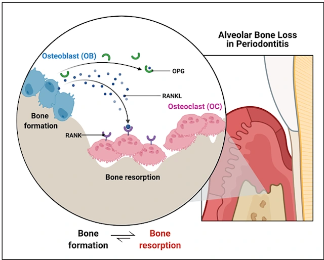 Osteoimmunology | Immunological and Inflammatory Aspects of Periodontal ...